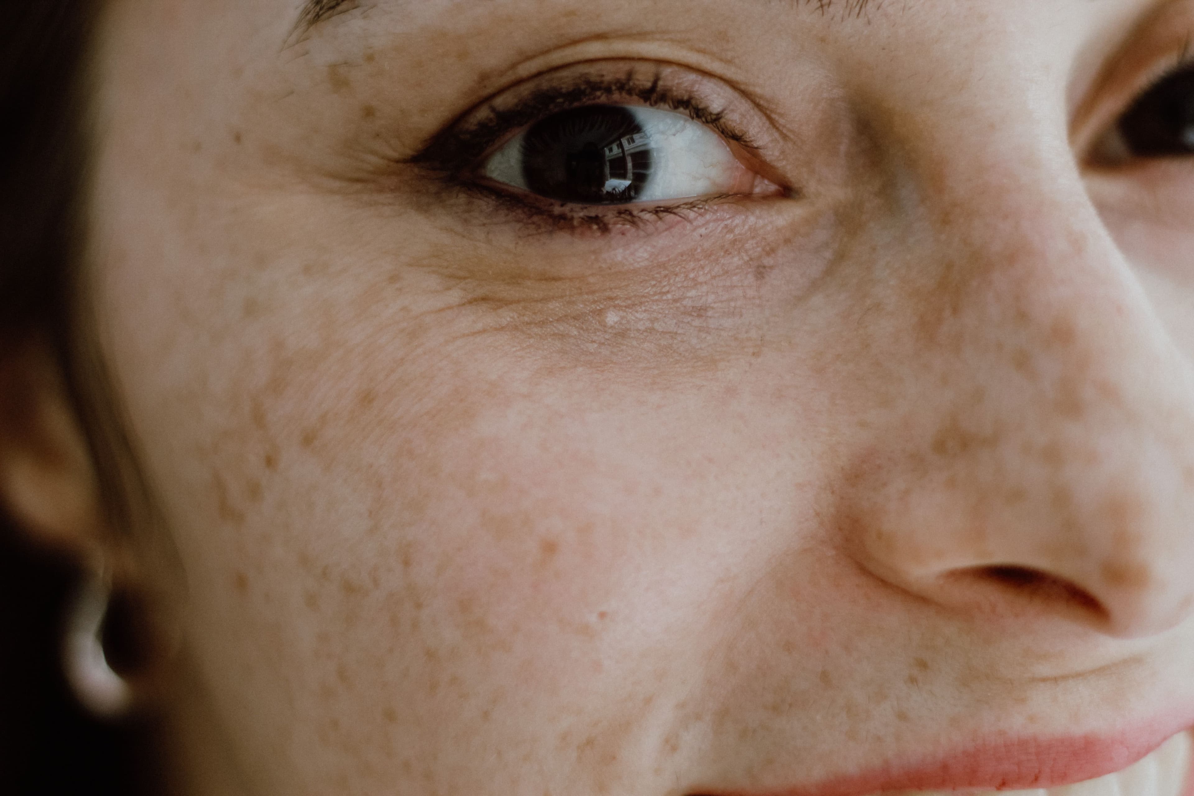Melasma no inverno: tratar a mancha exige olhar além da pigmentação